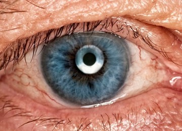 Глаукома ока